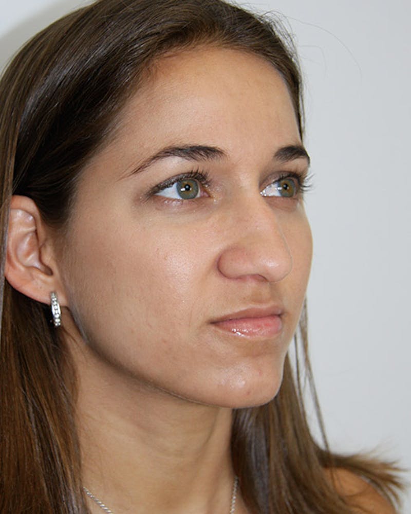 Rhinoplasty Before & After Gallery - Patient 143521972 - Image 3