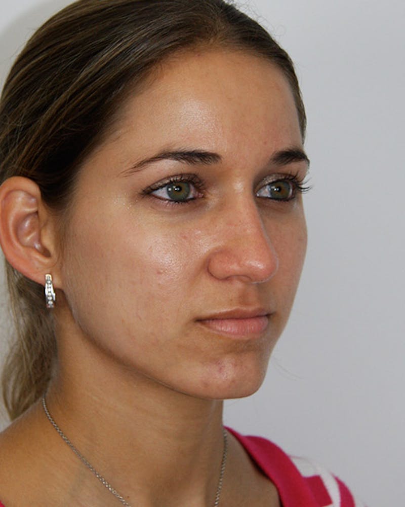 Rhinoplasty Before & After Gallery - Patient 143521972 - Image 4