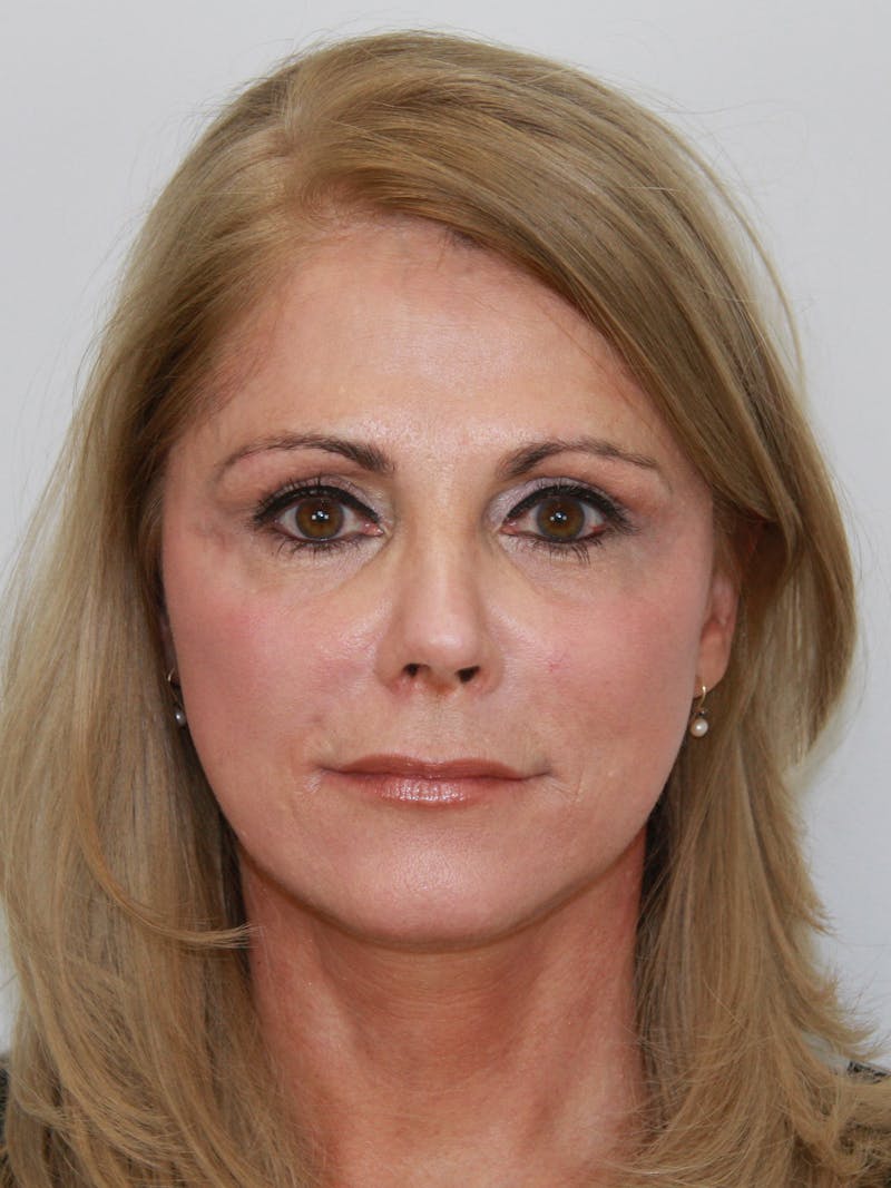 Facelift & Neck Lift Before & After Gallery - Patient 143521977 - Image 1