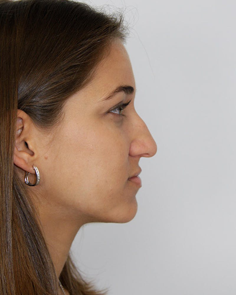 Rhinoplasty Before & After Gallery - Patient 143521972 - Image 5