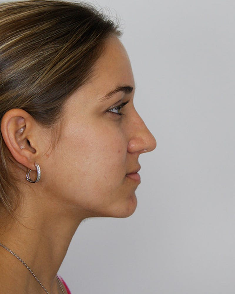 Rhinoplasty Before & After Gallery - Patient 143521972 - Image 6
