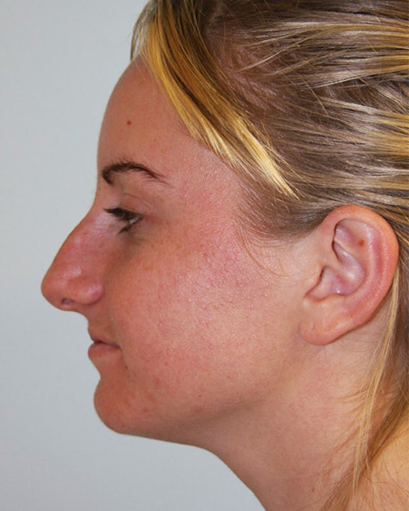Rhinoplasty Before & After Gallery - Patient 143521973 - Image 1