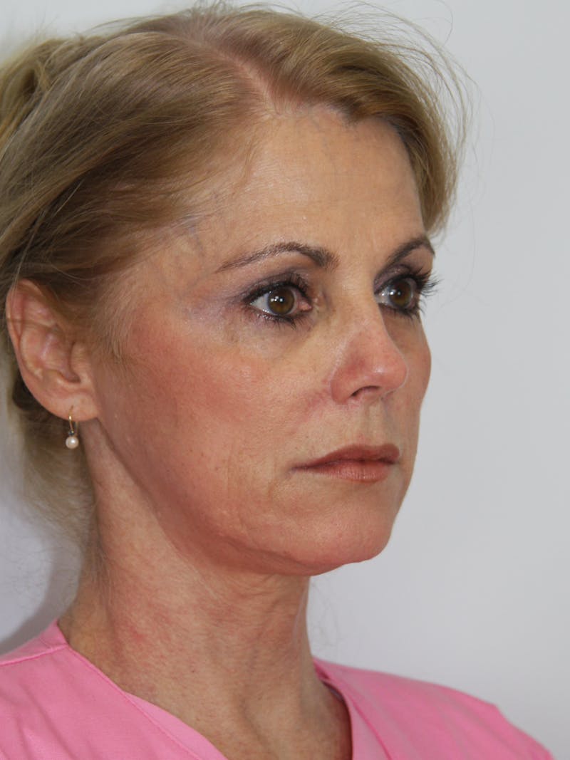 Facelift & Neck Lift Before & After Gallery - Patient 143521977 - Image 3