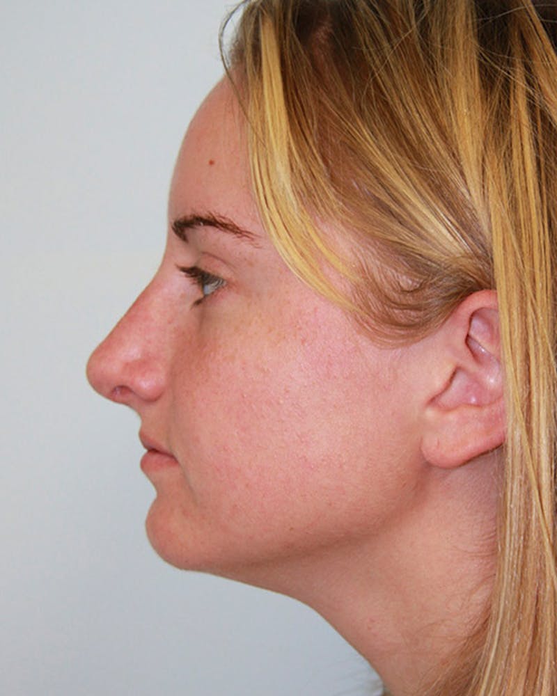 Rhinoplasty Before & After Gallery - Patient 143521973 - Image 2
