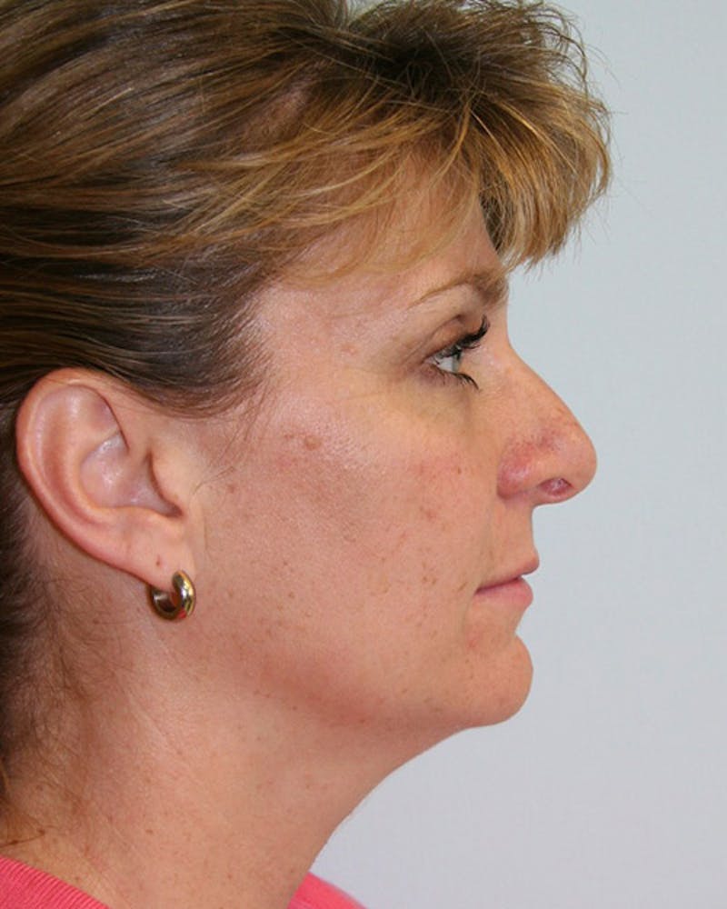 Rhinoplasty Before & After Gallery - Patient 143521976 - Image 3