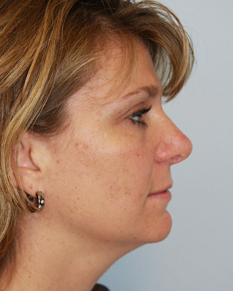 Rhinoplasty Before & After Gallery - Patient 143521976 - Image 4