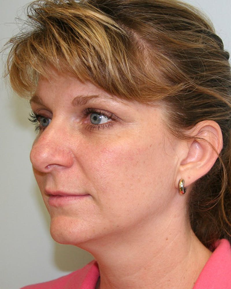 Rhinoplasty Before & After Gallery - Patient 143521976 - Image 5