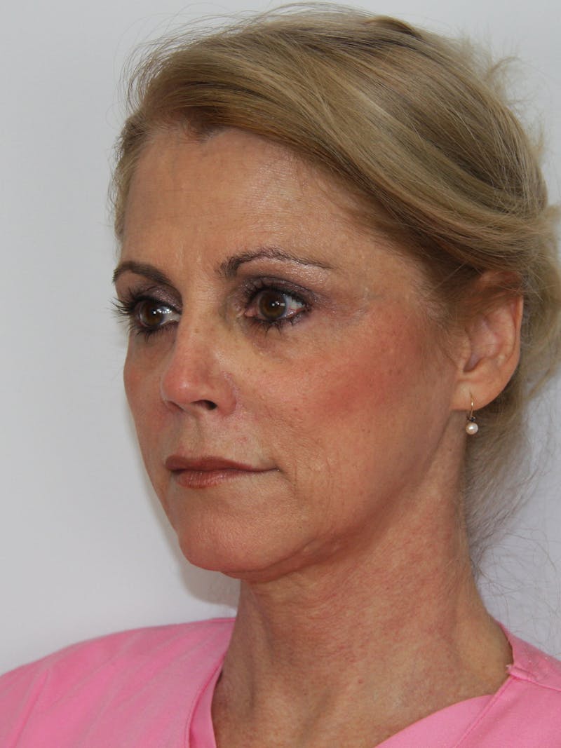 Facelift & Neck Lift Before & After Gallery - Patient 143521977 - Image 5