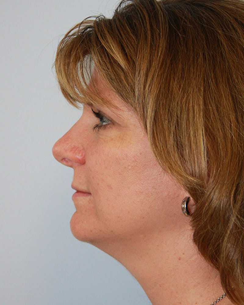 Rhinoplasty Before & After Gallery - Patient 143521976 - Image 8