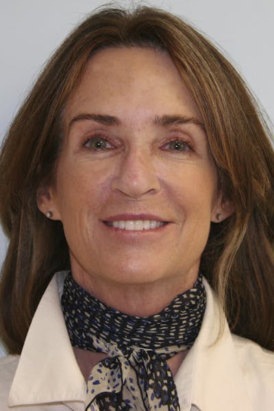 Eyelid Surgery Before & After Gallery - Patient 143521983 - Image 1