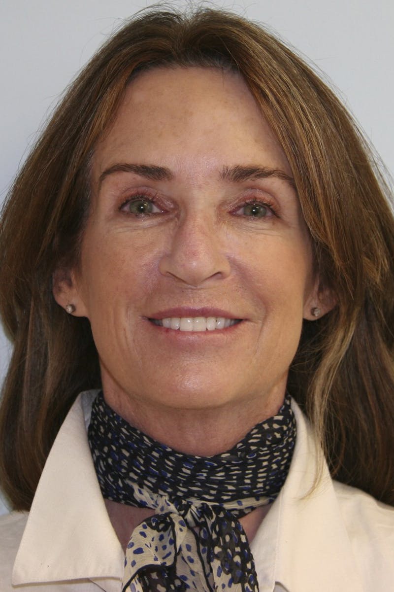 Eyelid Surgery Before & After Gallery - Patient 143521983 - Image 1