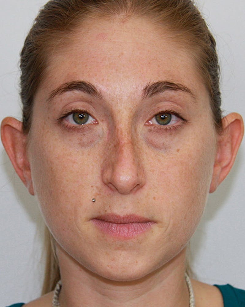 Rhinoplasty Before & After Gallery - Patient 143521978 - Image 1