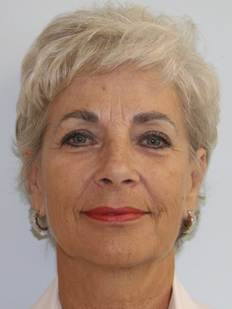 Facelift & Neck Lift Before & After Gallery - Patient 143521981 - Image 1