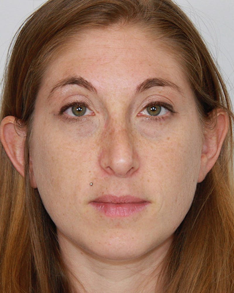 Rhinoplasty Before & After Gallery - Patient 143521978 - Image 2