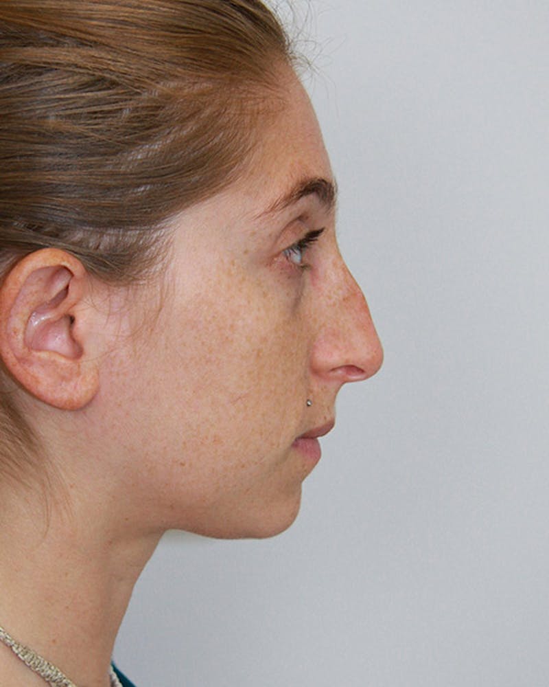 Rhinoplasty Before & After Gallery - Patient 143521978 - Image 3