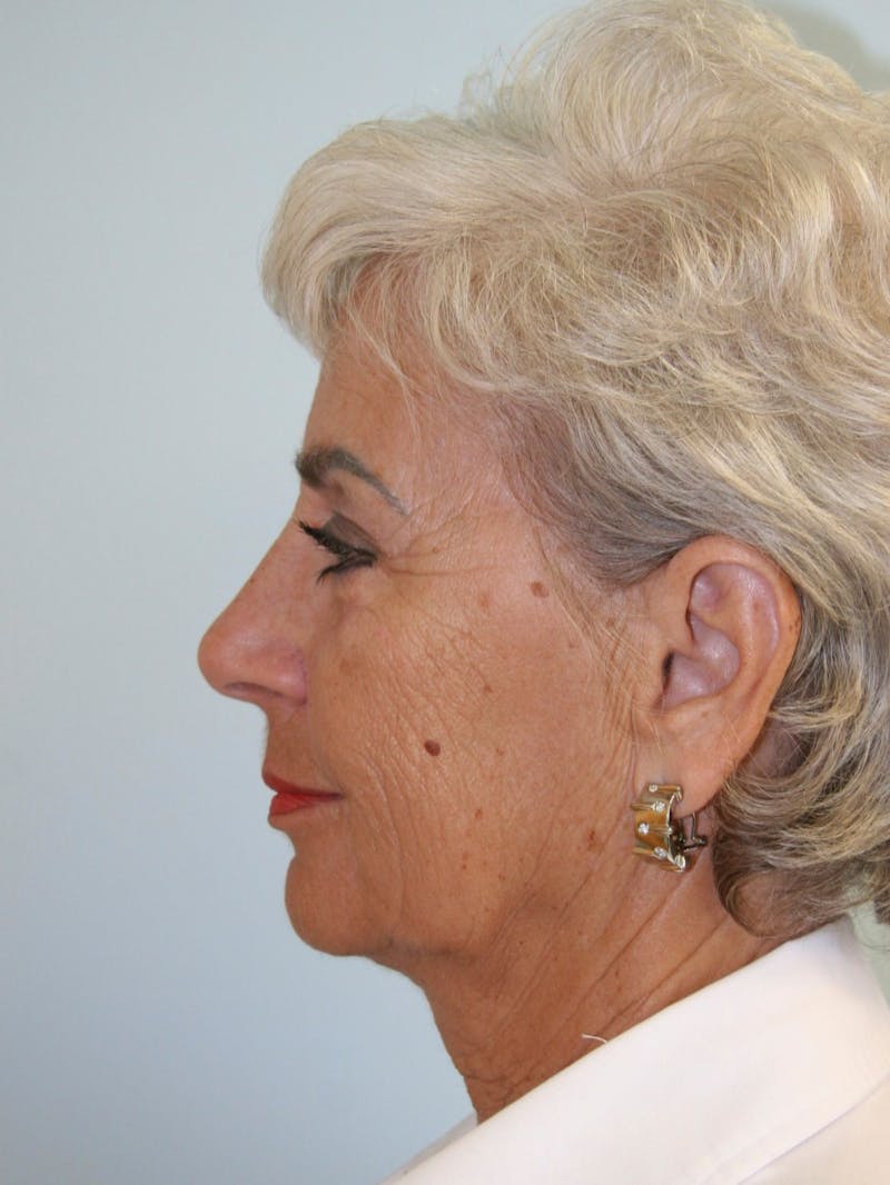 Facelift & Neck Lift Before & After Gallery - Patient 143521981 - Image 3