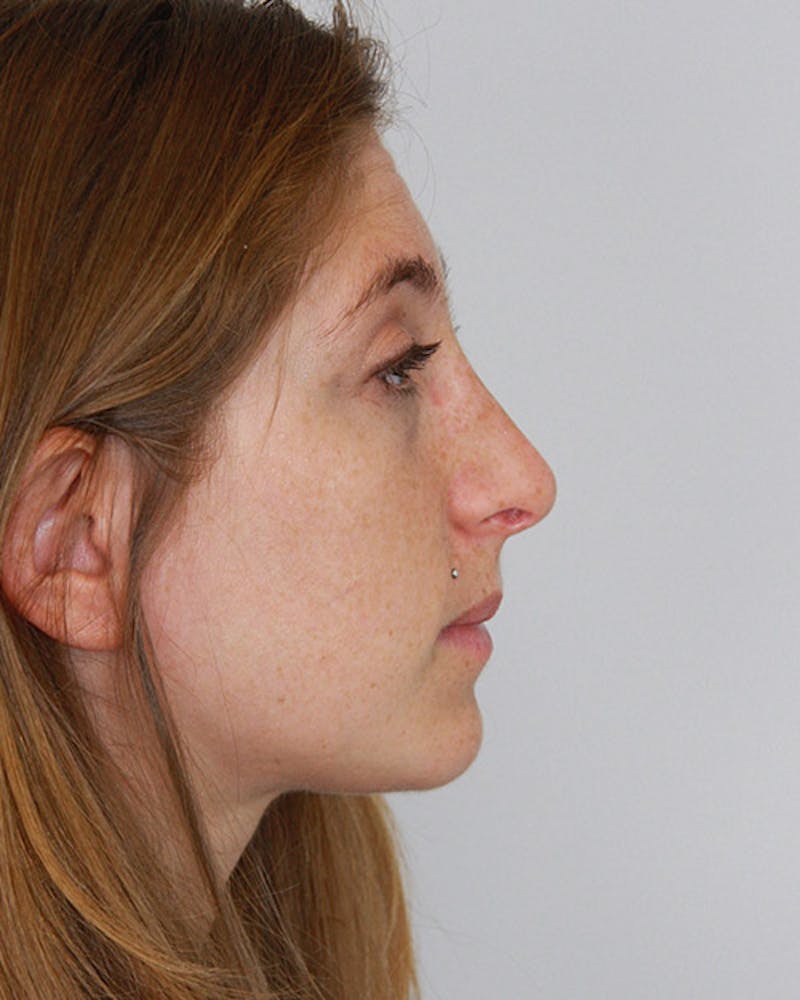 Rhinoplasty Before & After Gallery - Patient 143521978 - Image 4