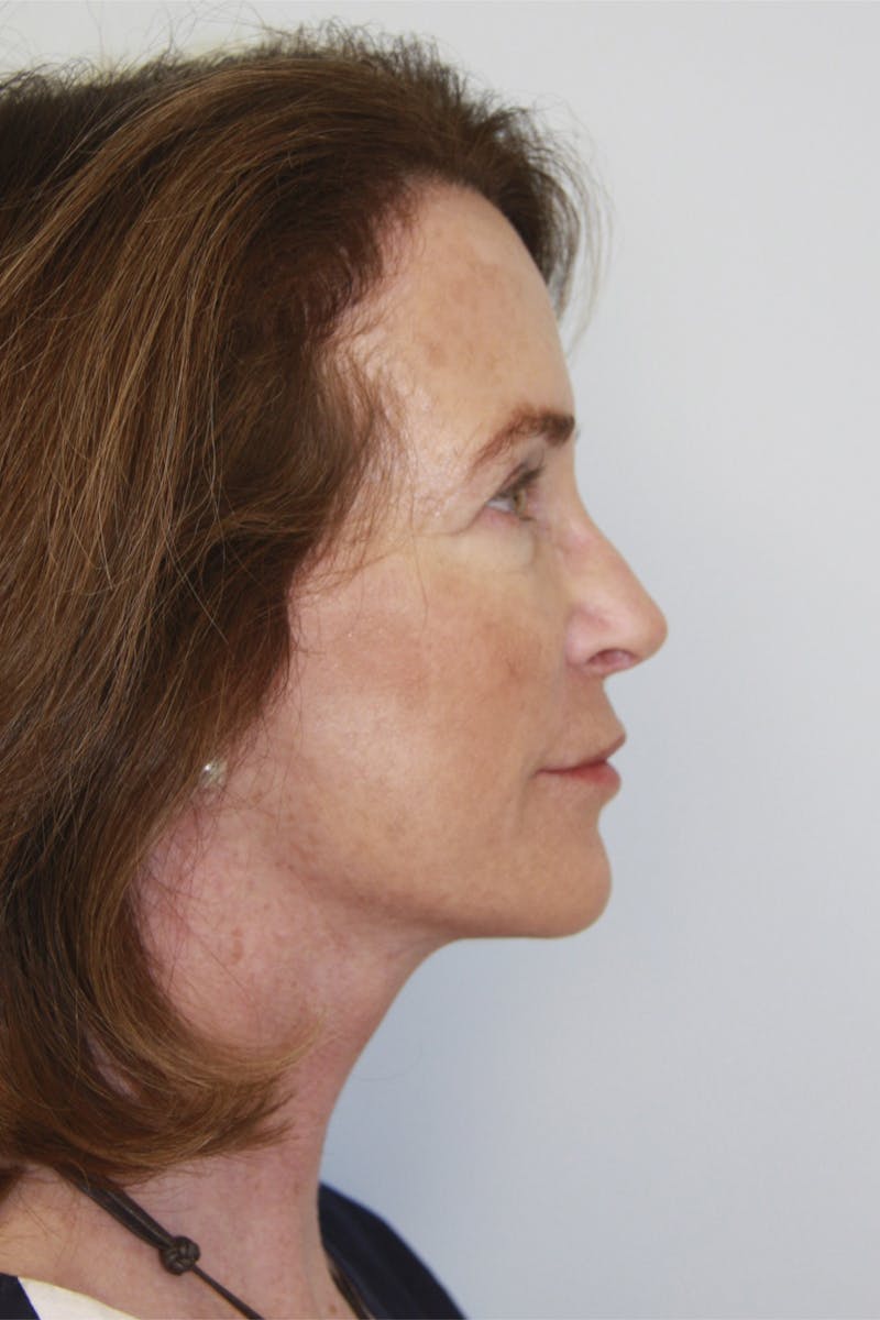 Eyelid Surgery Before & After Gallery - Patient 143521983 - Image 4