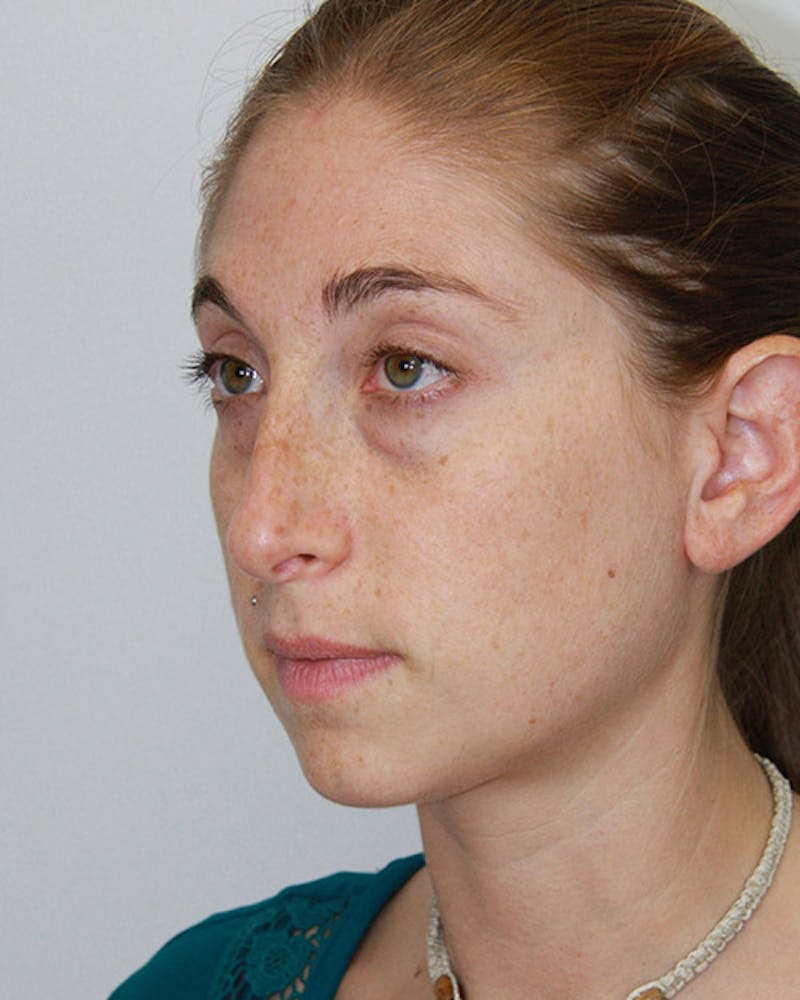 Rhinoplasty Before & After Gallery - Patient 143521978 - Image 5