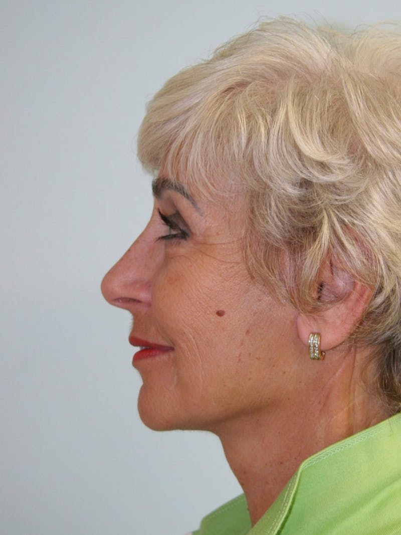 Facelift & Neck Lift Before & After Gallery - Patient 143521981 - Image 4