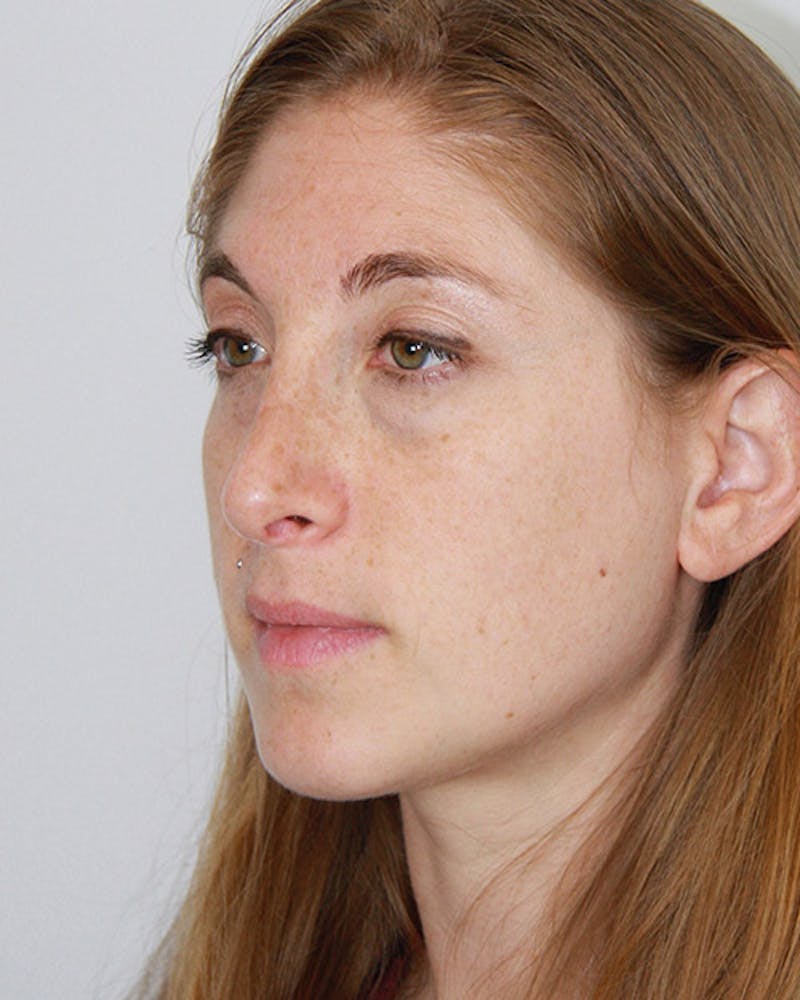 Rhinoplasty Before & After Gallery - Patient 143521978 - Image 6