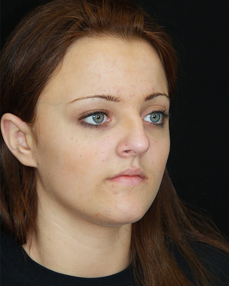 Rhinoplasty Before & After Gallery - Patient 143521982 - Image 1