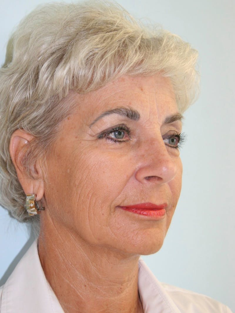 Facelift & Neck Lift Before & After Gallery - Patient 143521981 - Image 5