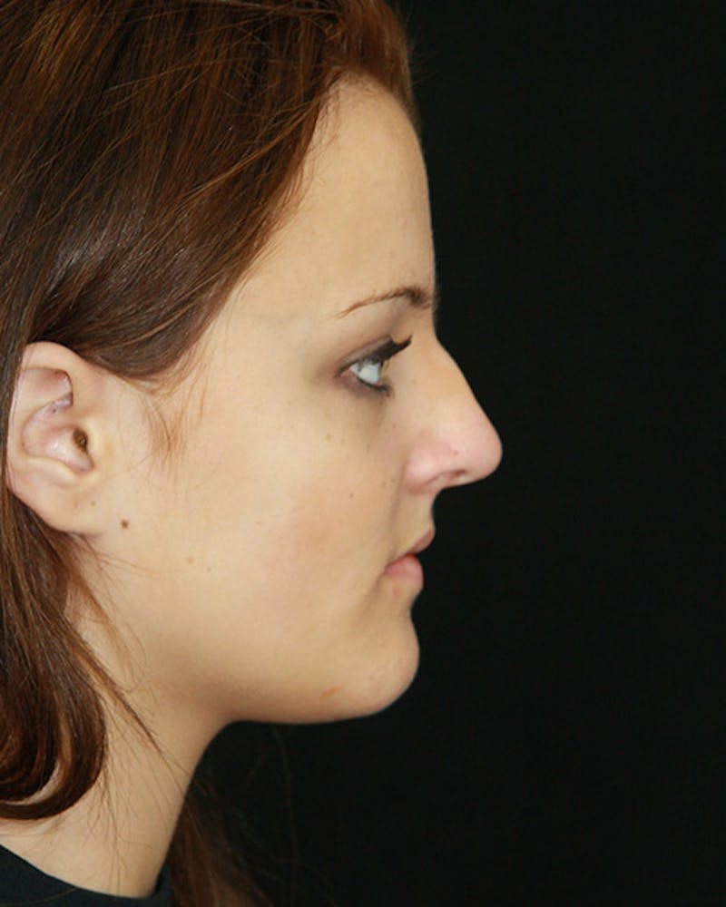 Rhinoplasty Before & After Gallery - Patient 143521982 - Image 3