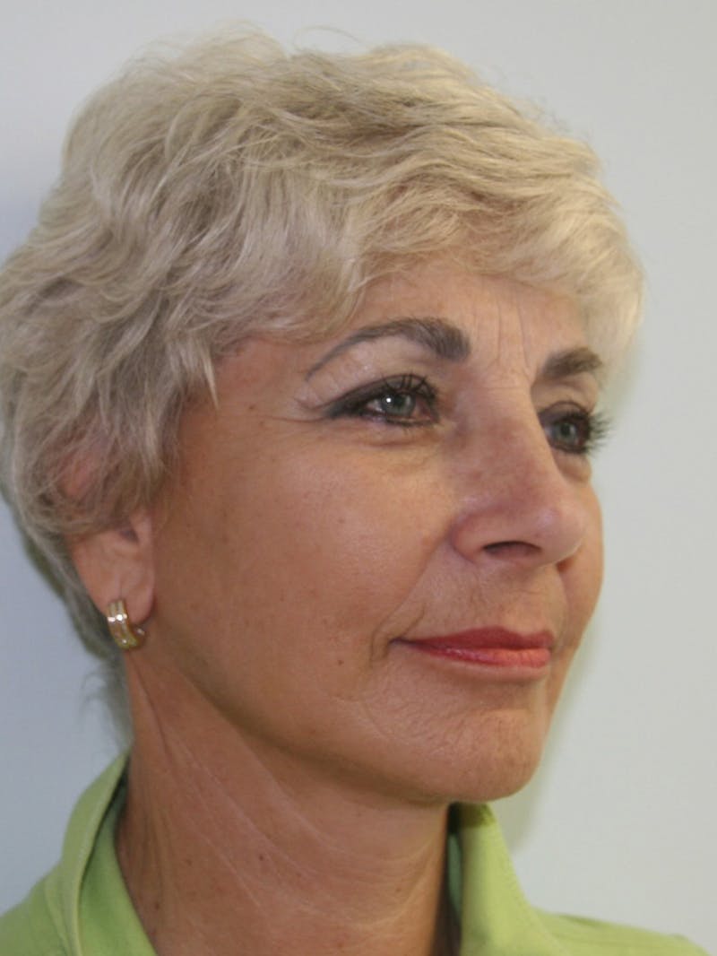 Facelift & Neck Lift Before & After Gallery - Patient 143521981 - Image 6