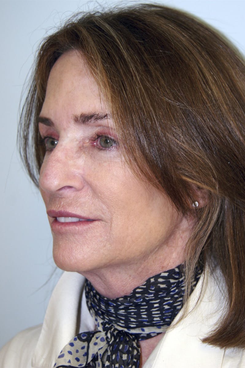Eyelid Surgery Before & After Gallery - Patient 143521983 - Image 7