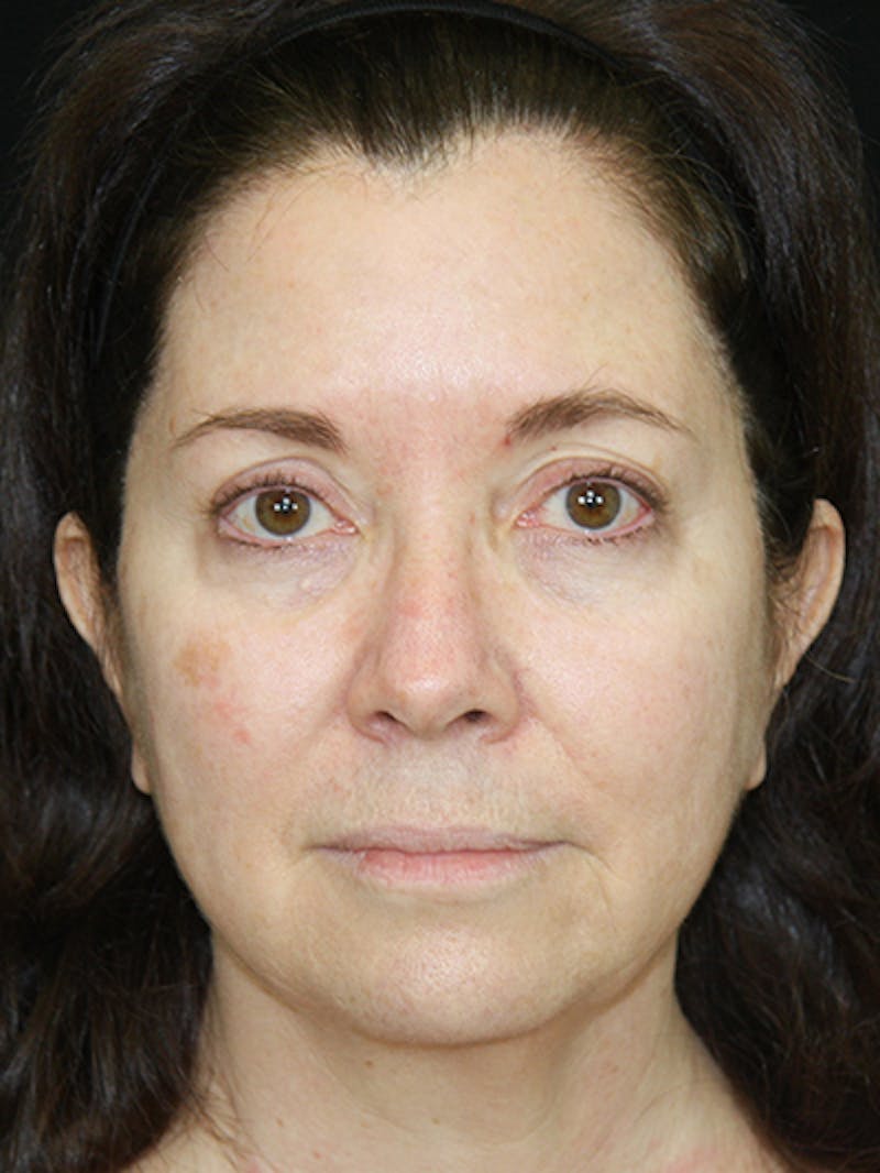 Facelift & Neck Lift Before & After Gallery - Patient 143521985 - Image 1