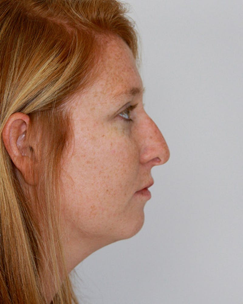 Rhinoplasty Before & After Gallery - Patient 143521984 - Image 1
