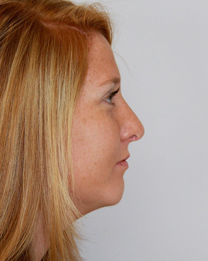 Rhinoplasty Before & After Gallery - Patient 143521984 - Image 2