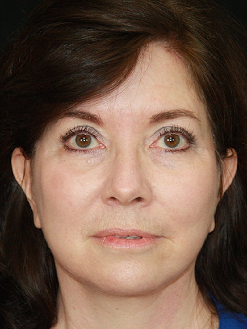 Facelift & Neck Lift Before & After Gallery - Patient 143521985 - Image 2