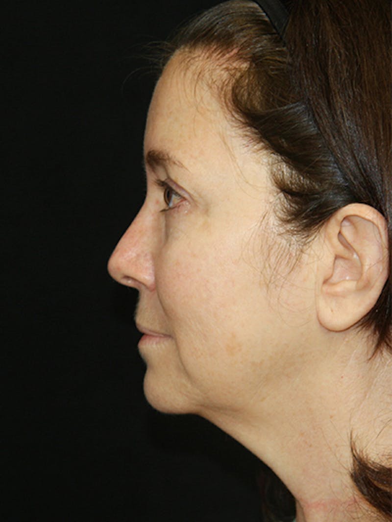 Facelift & Neck Lift Before & After Gallery - Patient 143521985 - Image 3