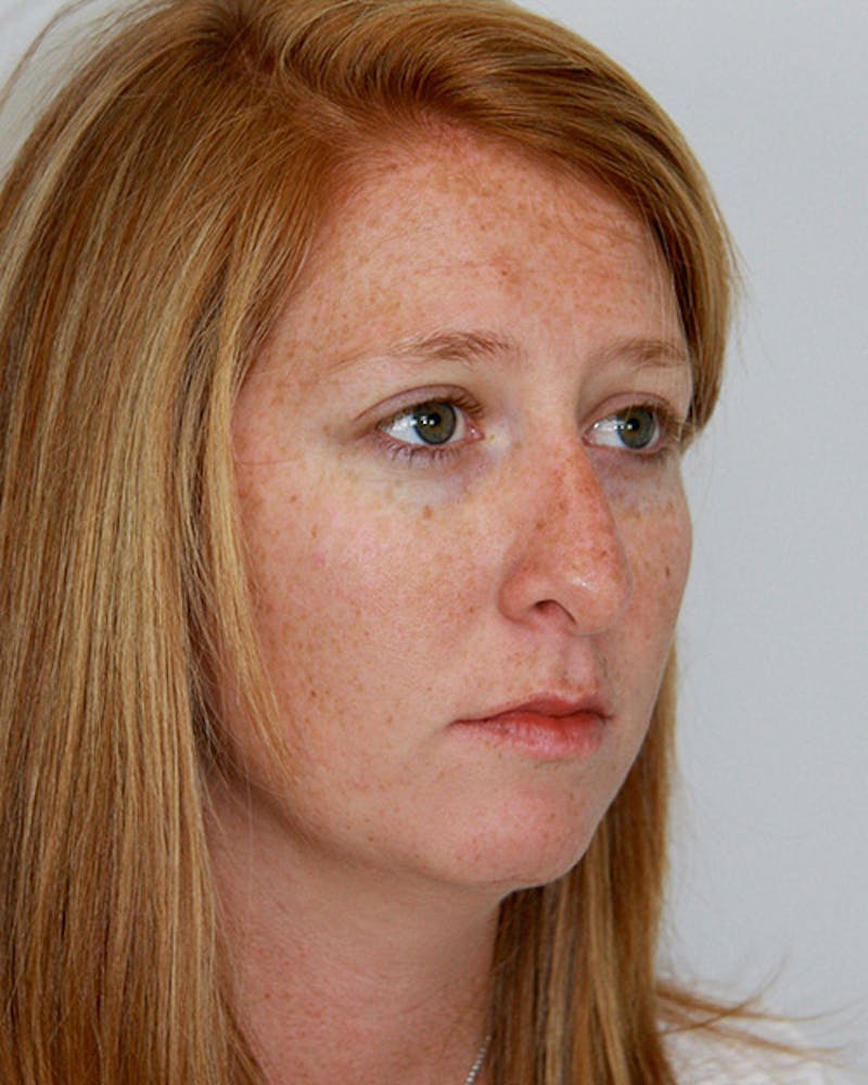 Rhinoplasty Before & After Gallery - Patient 143521984 - Image 3