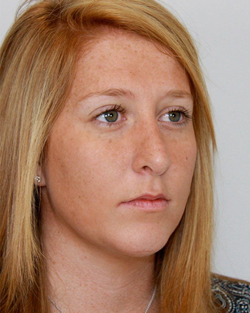 Rhinoplasty Before & After Gallery - Patient 143521984 - Image 4