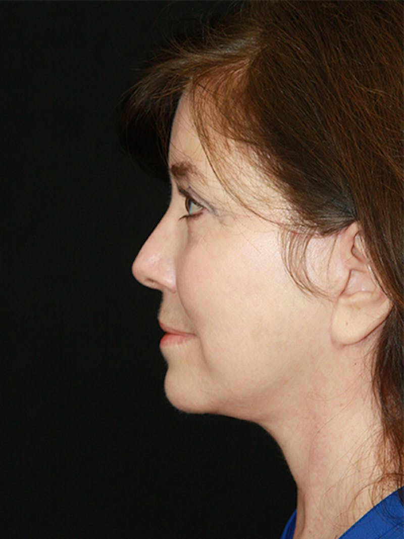 Facelift & Neck Lift Before & After Gallery - Patient 143521985 - Image 4