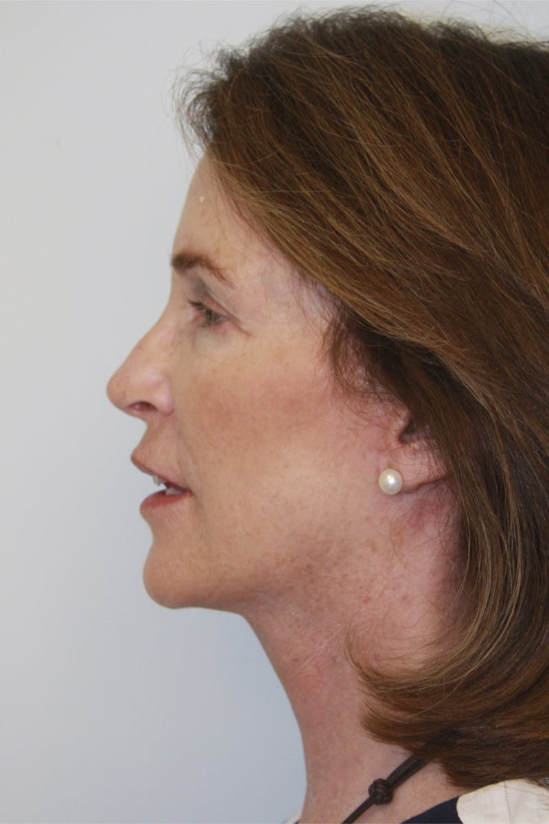 Eyelid Surgery Before & After Gallery - Patient 143521983 - Image 10