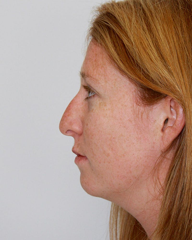 Rhinoplasty Before & After Gallery - Patient 143521984 - Image 5