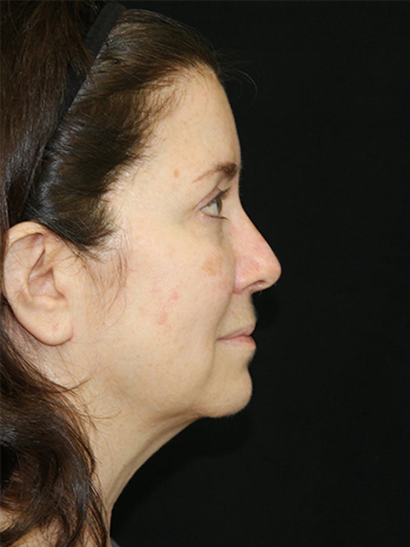 Facelift & Neck Lift Before & After Gallery - Patient 143521985 - Image 5