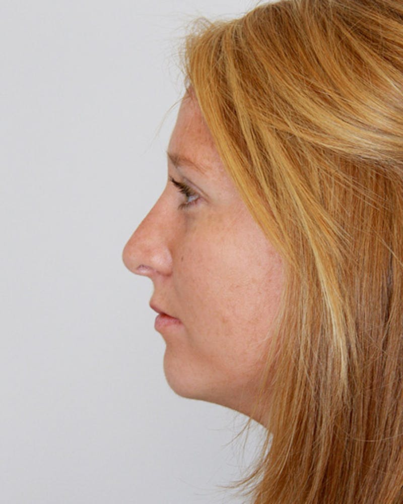 Rhinoplasty Before & After Gallery - Patient 143521984 - Image 6