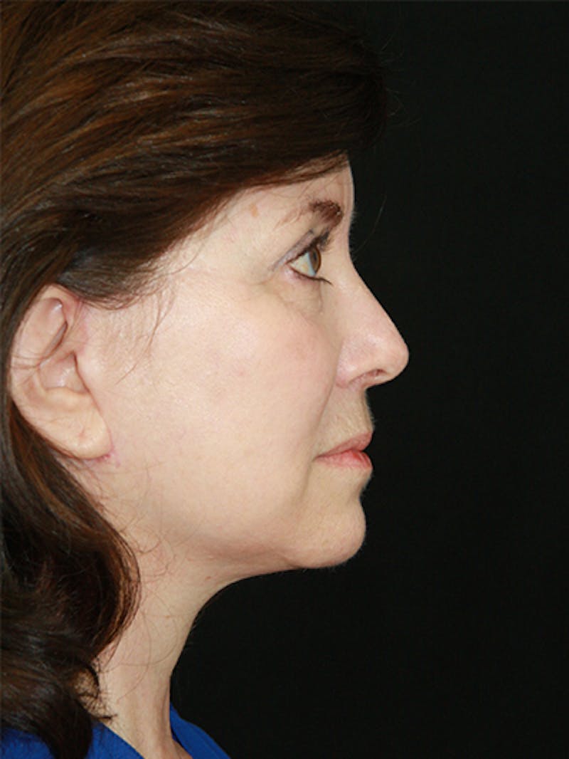 Facelift & Neck Lift Before & After Gallery - Patient 143521985 - Image 6