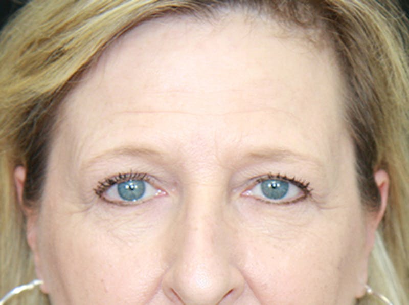 Eyelid Surgery Before & After Gallery - Patient 143521987 - Image 1