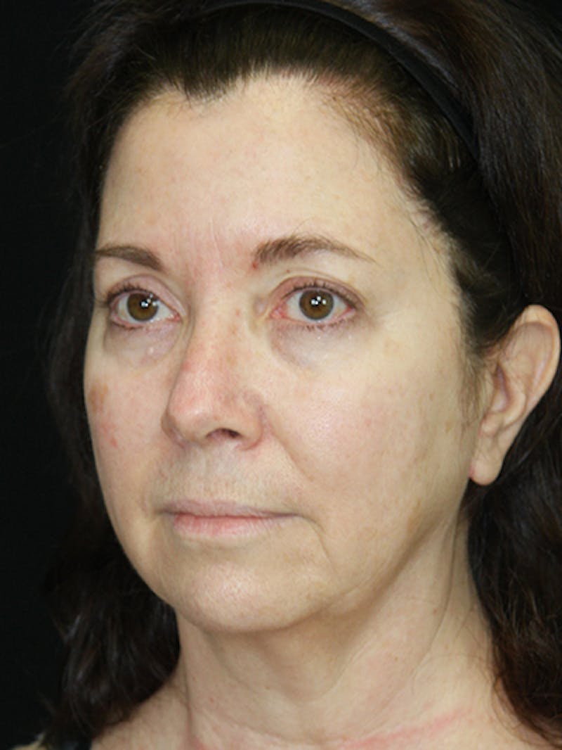 Facelift & Neck Lift Before & After Gallery - Patient 143521985 - Image 7