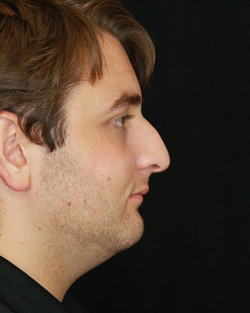 Rhinoplasty Before & After Gallery - Patient 143521986 - Image 1