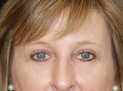 Eyelid Surgery Before & After Gallery - Patient 143521987 - Image 2