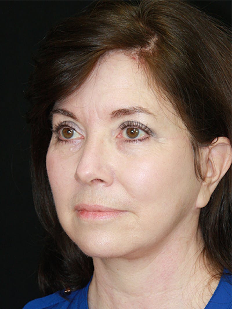 Facelift & Neck Lift Before & After Gallery - Patient 143521985 - Image 8