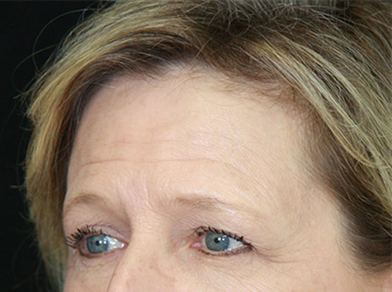 Eyelid Surgery Before & After Gallery - Patient 143521987 - Image 3