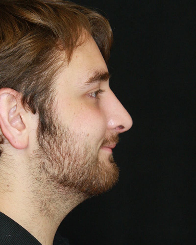Rhinoplasty Before & After Gallery - Patient 143521986 - Image 2